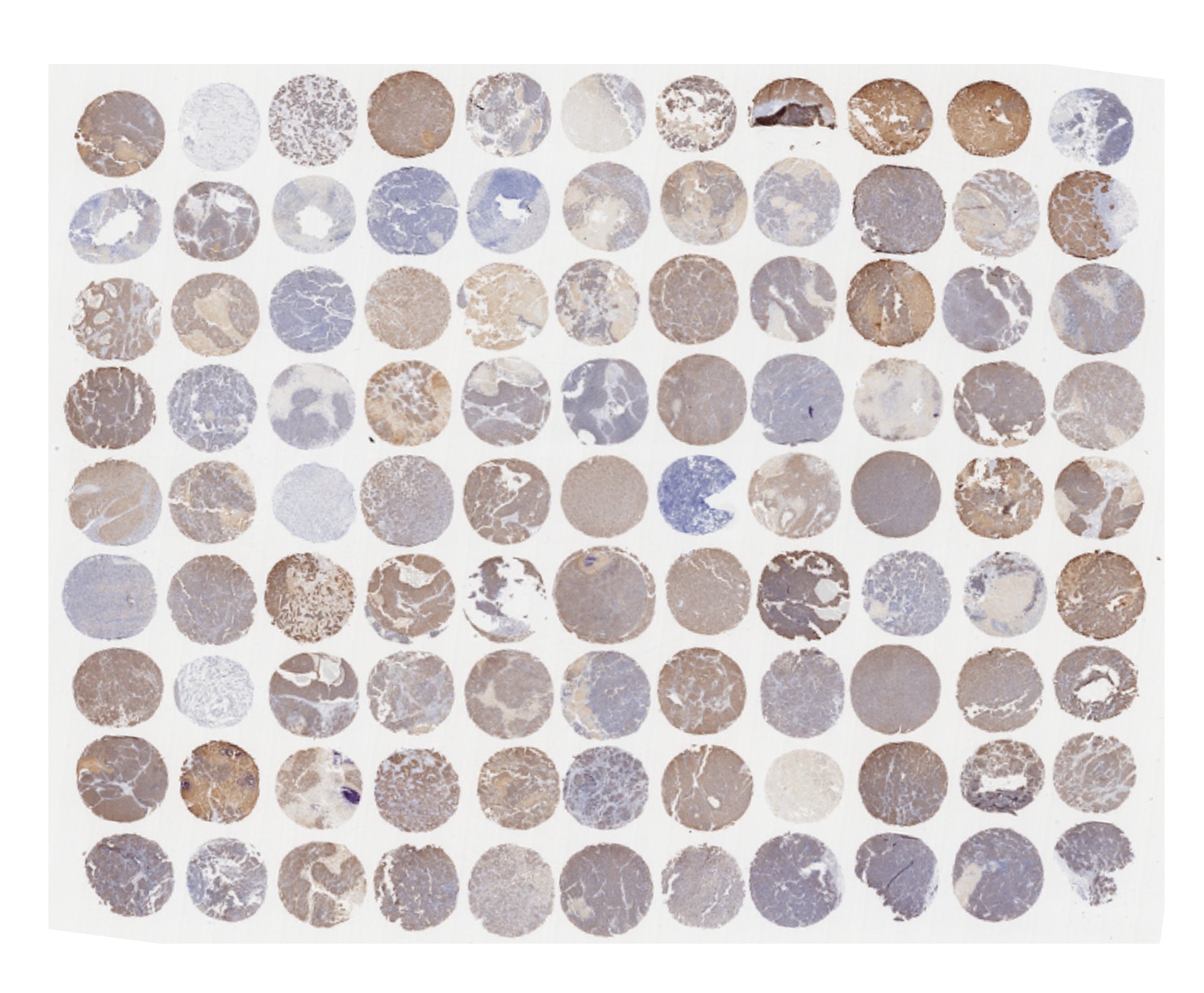 Her2 IHC staining of a breast cancer Tissue Microarrays (TMA)